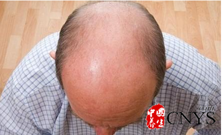 男性秃顶的6大健康危机 秃顶怎么办?