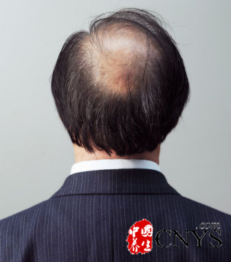 男性秃顶隐藏六信号 心脏病风险高免疫系统障碍